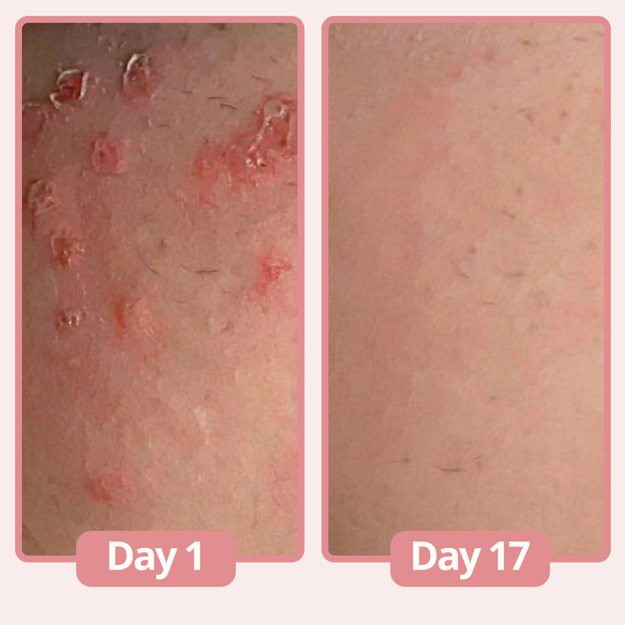 Lunelle® Women's Genital Relief Cream